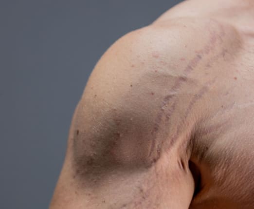 stretch-marks-arm